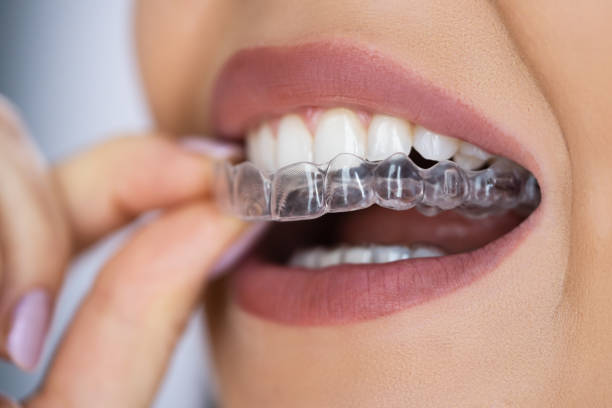 Aligneur invisible — gouttière transparente sur-mesure