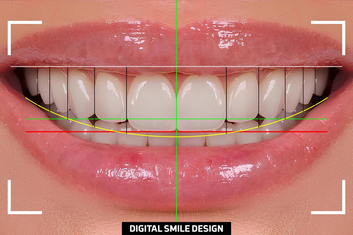 Digital Smile Design — conception numérique du sourire