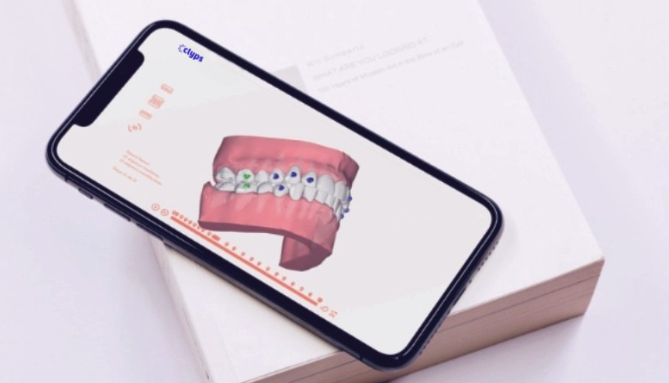 Suivi numérique 3D du traitement orthodontique